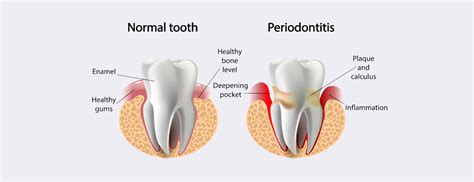 gum disease treatment near me|Periodontitis .